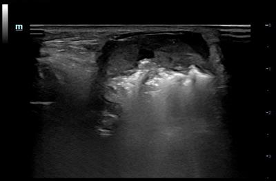 Case Report: A case of radioactive iodine-refractory thyroid cancer accompanying cervical lymph node metastasis treated with US-guided RFA combined with 125I seed implantation
